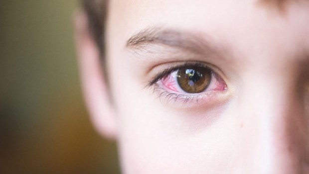 Cómo prevenir la conjuntivitis en épocas de pileta