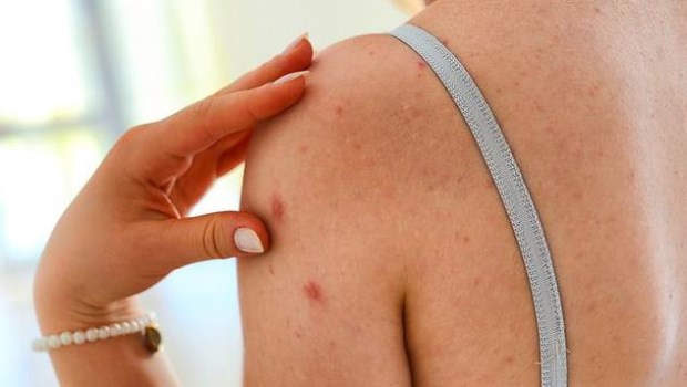 Alerta en Buenos Aires: Una mujer murió a causa de sarampión y un hombre de dengue