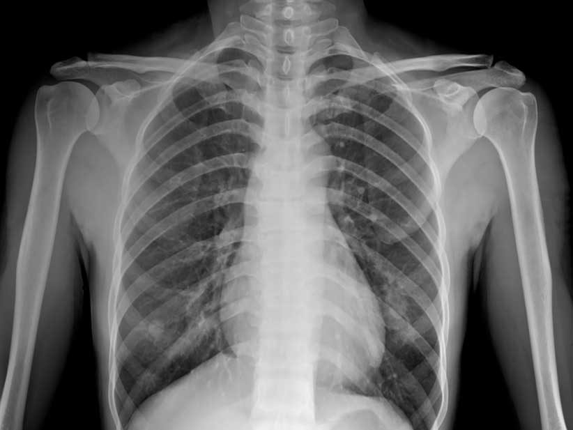 Los cuatros tipos de pacientes con coronavirus COVID-19 y qué le pasa a los pulmones de acuerdo a la gravedad del cuadro