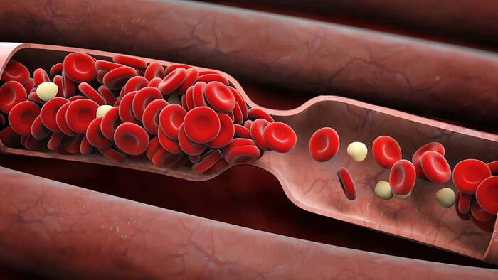 Una de cada cuatro personas muere por causas vinculadas  a la trombosis