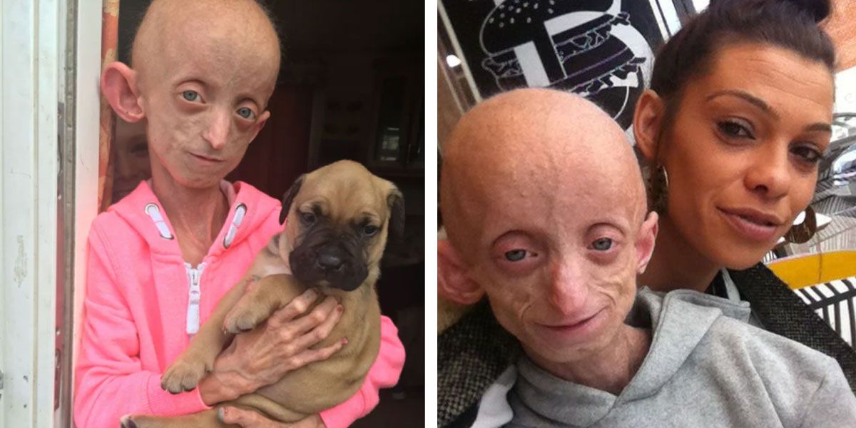 Como Benjamin Button: una adolescente murió con el cuerpo de una mujer de 144 años