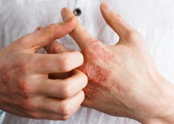 Desarrollan una campaña para detectar casos de psoriasis en el departamento