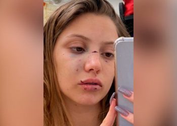 La confundieron con otra mujer y le pegaron con una frapera: Le fracturaron los pómulos, la nariz y perdió dos dientes