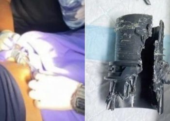 Se agrandó el pene y le quedó atascado en un tubo que usó para comprobar el tamaño