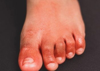 Detectaron un insólito síntoma en los pies de pacientes infectados con Ómicron