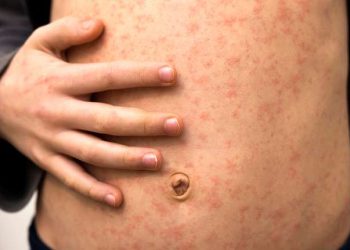 Se detectó un probable caso de sarampión en el país y emitieron una alerta epidemiológica