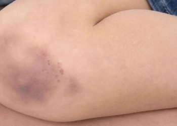 San Juan: Denunciaron a una mujer que golpeó a su hija con una tabla por no saber las letras