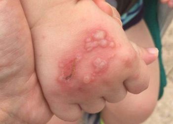 Qué es la enfermedad de mano-pie-boca, que volvió tras el fin del aislamiento en los jardines de infantes