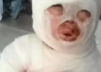 Una empleada de un restaurante se tropezó y le volcó aceite hirviendo a una nena de 3 años: tiene quemaduras en el 54% de su cuerpo 
