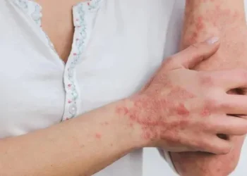 Avanza la viruela del mono en el mundo