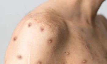 Alerta: Confirman el segundo caso de viruela del mono en la Argentina