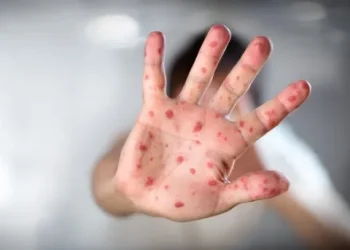 Brote: Cuáles son los síntomas de la viruela del mono