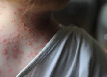 Viruela del mono: Mendoza está en alerta y Salud analiza los pasos a seguir