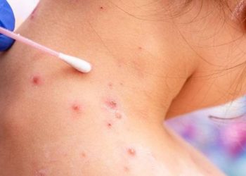 Chile declaró alerta sanitaria por seis casos de viruela del mono en una semana
