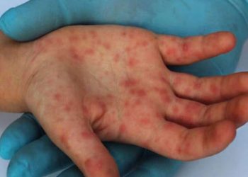 Viruela de mono: detectaron el primer caso sospechoso en Mendoza