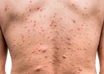 Viruela del mono: cuándo se sabrá si es positivo el caso sospechoso en Mendoza