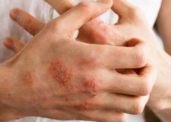 Explicaron en qué  consiste la enfermedad de la piel denominada Esclerodermia