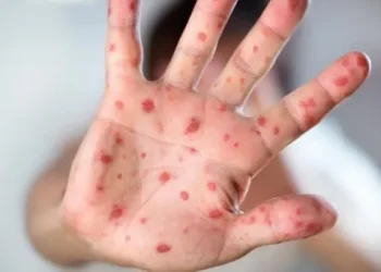 Vuelve la rubéola: detectan el primer caso en Bolivia en 16 años