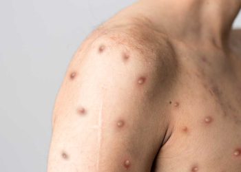 Alerta en el mundo: ¿Qué significa que la viruela del mono sea una emergencia internacional?