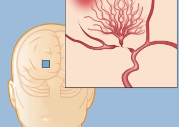 Un joven debe operarse en Buenos Aires para evitar un nuevo ACV  y su familia reúne fondos para costear el viaje