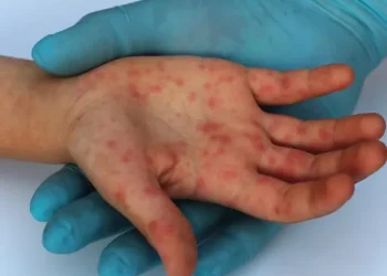 Después del coronavirus y la viruela del mono llega la gripe del tomate: qué es