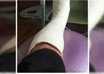 Viral: Ofrecen yesos truchos para faltar al trabajo y ver a la «Scaloneta» durante el Mundial