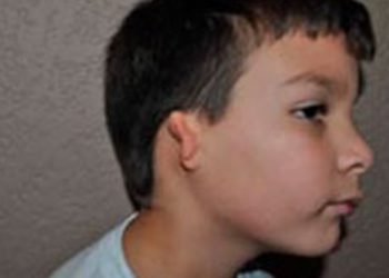 Investigan casos de microtia, una malformación congénita en la oreja que puede causar hipoacusia