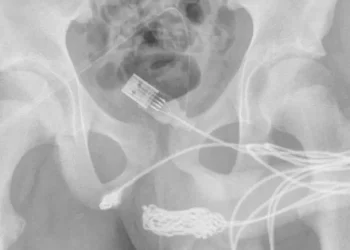 Se le atascó un cable USB en el pene: ¿qué tuvieron que hacer los médicos?