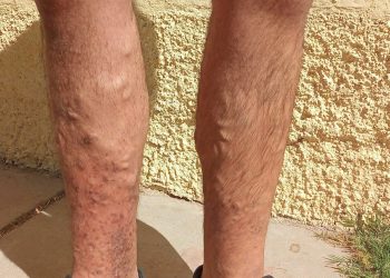 Realizan una rifa para ayudar  a un hombre que requiere una cirugía para no perder sus piernas