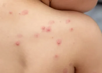 Se confirmó la primera muerte por viruela del mono en Argentina