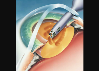 Juntan fondos  para ayudar a un niño que requiere un implante intraocular