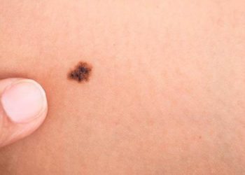 Pensó que tenía una mancha de nacimiento, fue al dermatólogo y el diagnóstico le cambió la vida: “Haberme caído”