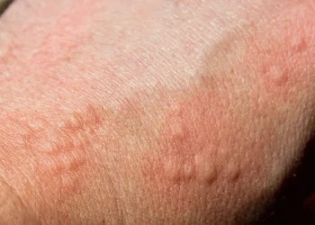 ¿Cuál es la nueva enfermedad poco frecuente que reconoció Argentina?