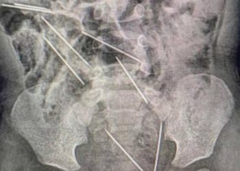 Llevó a su hijo de 2 años con fuertes dolores al hospital y tuvieron que operarlo de urgencia por lo que se había tragado