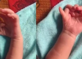 Una beba nació con 7 dedos en cada mano y 6 en cada pie