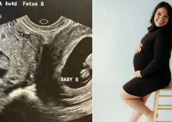 Mujer con inusual útero doble está embarazada en ambos