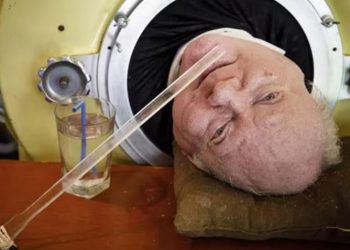 Murió Paul Alexander, el hombre que vivió durante más de 70 años conectado a un pulmón de hierro