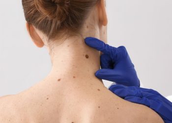 Día Mundial del Melanoma: un llamado a la prevención y la conciencia