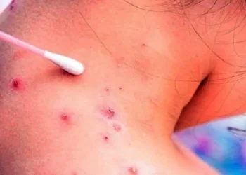 Viruela del mono en Argentina: suben a 8 los casos, pero no son de la variante más contagiosa