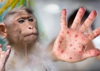 Alerta: Confirmaron un caso de viruela del mono en Corrientes y es el sexto en Argentina