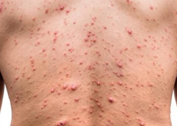 Confirmaron el primer caso autóctono de viruela del mono en Argentina