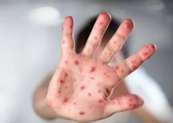 Viruela del mono: cuál es la situación en Mendoza