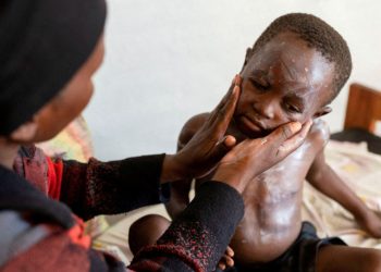 Alertan que la desnutrición en la República Democrática del Congo aumenta el riesgo por la viruela del mono en niños y embarazadas