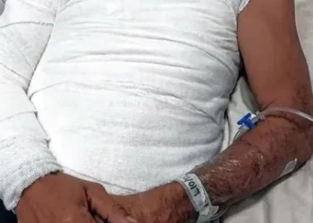 Dos hermanos se pelearon por un sachet de mayonesa y uno terminó con el cuerpo quemado