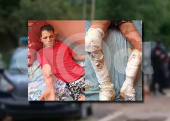 Se quemó el cuerpo por accidente y no fue al hospital porque lo buscaban por un asesinato