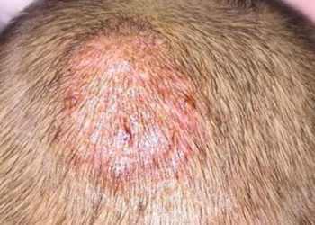 Se propaga una epidemia silenciosa de verano: cómo prevenir la tiña capilar