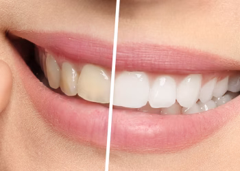 El truco chino para blanquear los dientes en 2 minutos