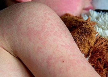El sarampión vuelve a preocupar: advierten sobre su contagio y en qué casos puede ser fatal