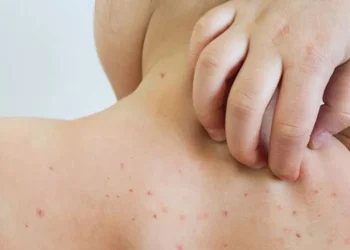 Crecen los casos de sarampión en el país: la advertencia de Salud para los mendocinos