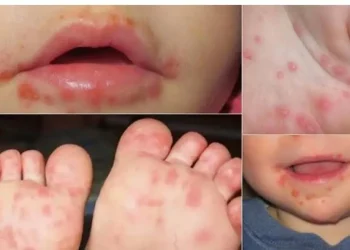 Atención: Crecen en Mendoza los casos de una enfermedad muy contagiosa que afecta a menores de 5 años